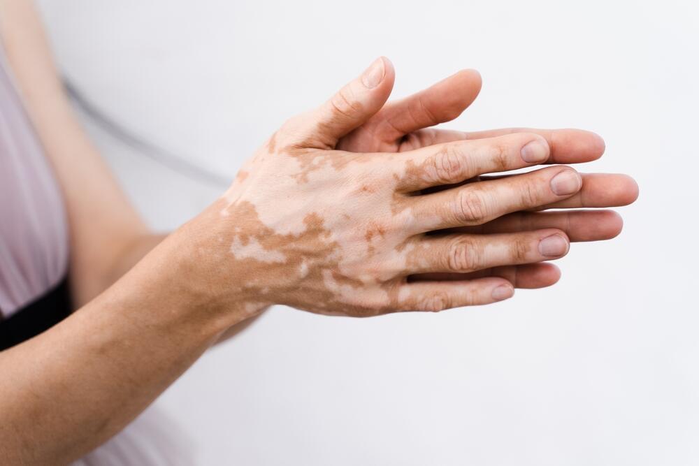 Vitiligo