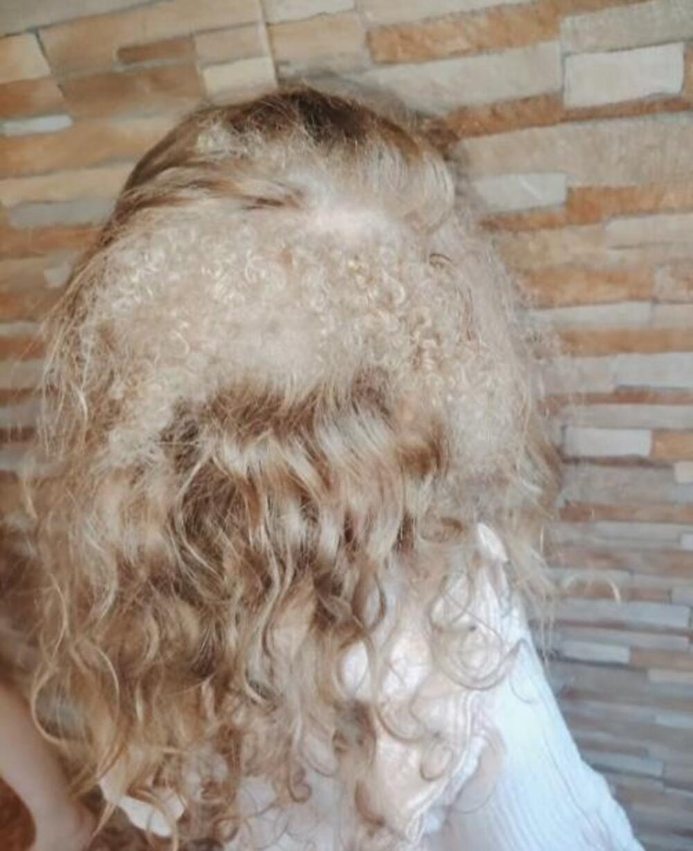 Софија, Лесковац, синдром на неисчешлана коса, синдром на нескротлива коса
