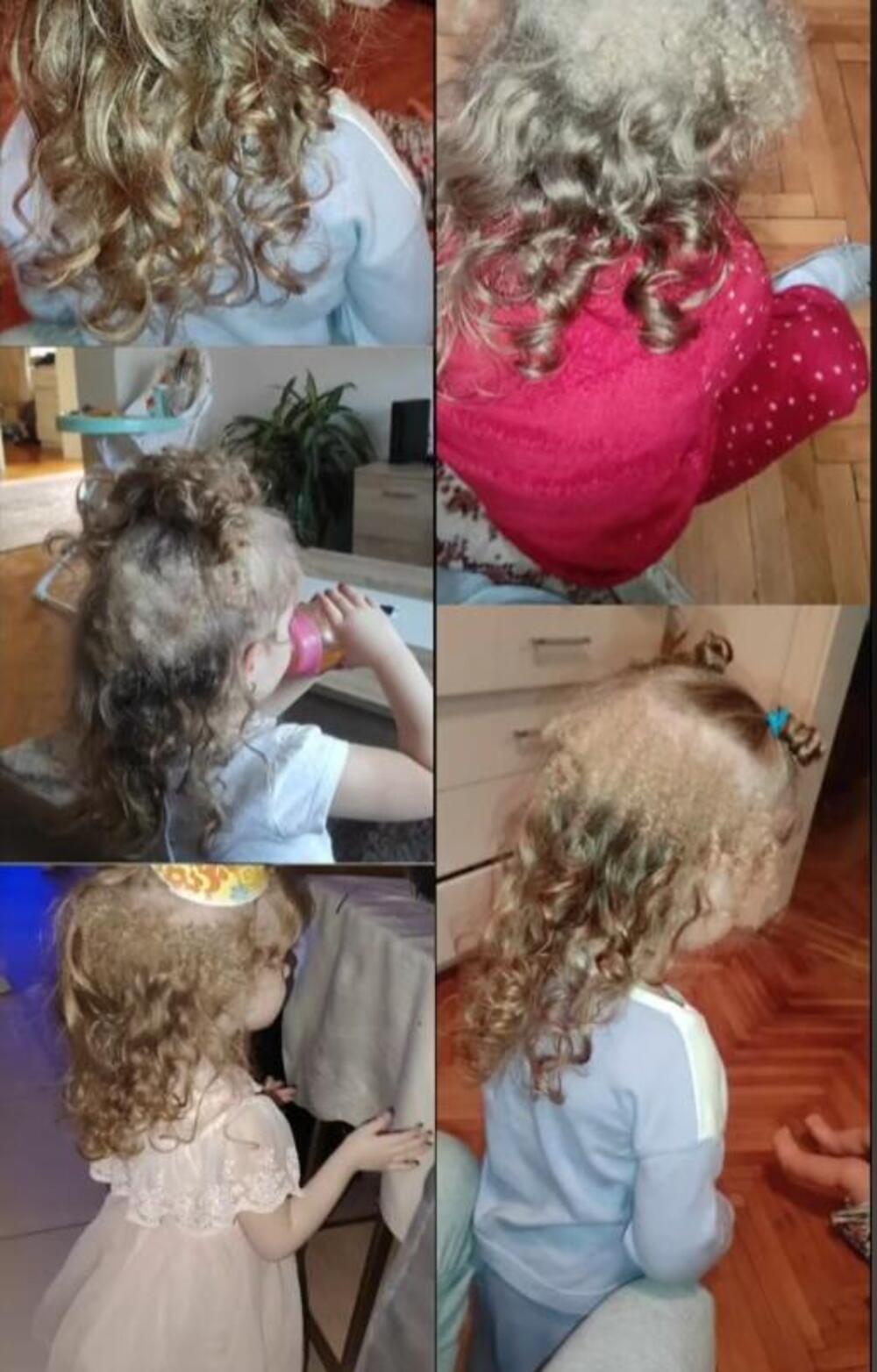 Софија, Лесковац, синдром на неисчешлана коса, синдром на нескротлива коса