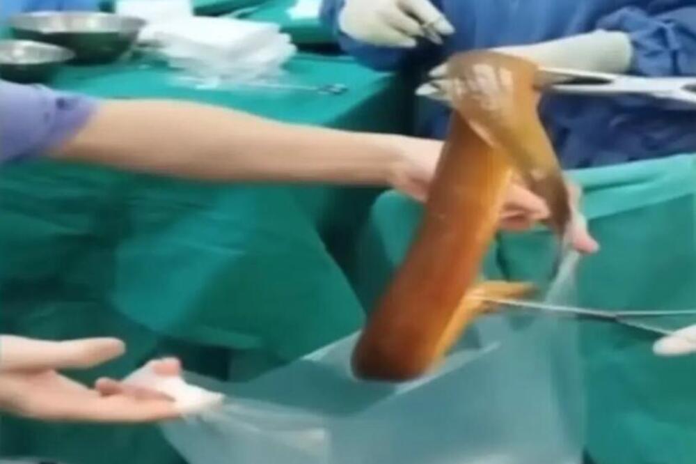 ŽIVI MONSTRUM OD 65 CM IZVAĐEN IZ STOMAKA PACIJENTA: Doktori nisu verovali šta se dešava kad je primljen u bolnicu (FOTO/VIDEO)